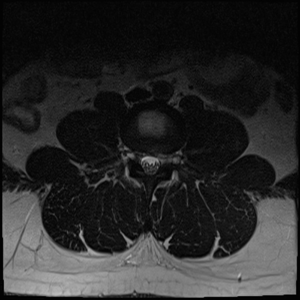 File:Normal lumbar spine MRI (Radiopaedia 47857-52609 Axial T2 5).jpg
