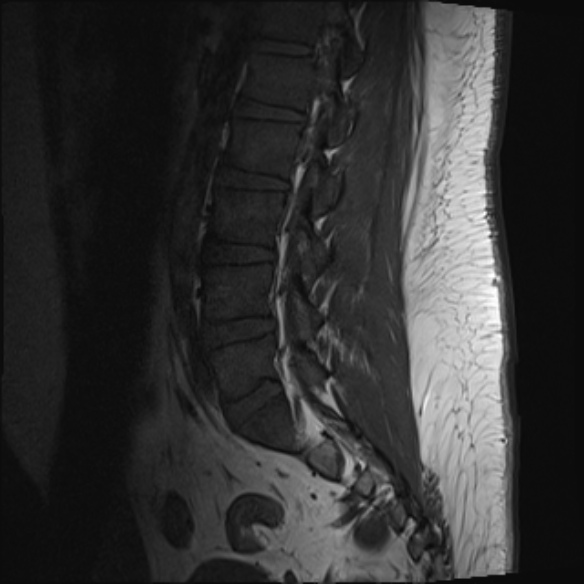 File:Normal lumbar spine MRI (Radiopaedia 47857-52609 Sagittal T1 13).jpg