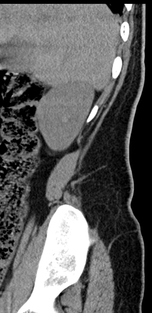Normal lumbosacral CT (Radiopaedia 37923-39867 E 103).png