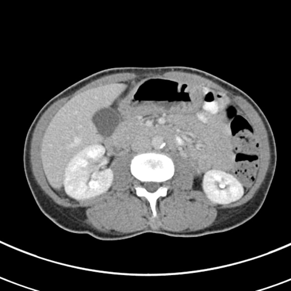 File:Normal multiphase CT liver (Radiopaedia 38026-39996 C 40).jpg