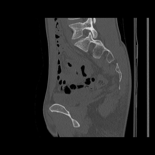 Normal pelvis (Radiopaedia 51473-57238 Sagittal bone window 86).jpg