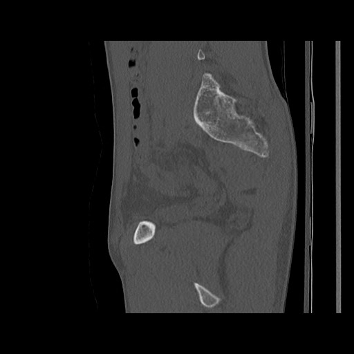 Normal pelvis (Radiopaedia 51473-57238 Sagittal bone window 95).jpg
