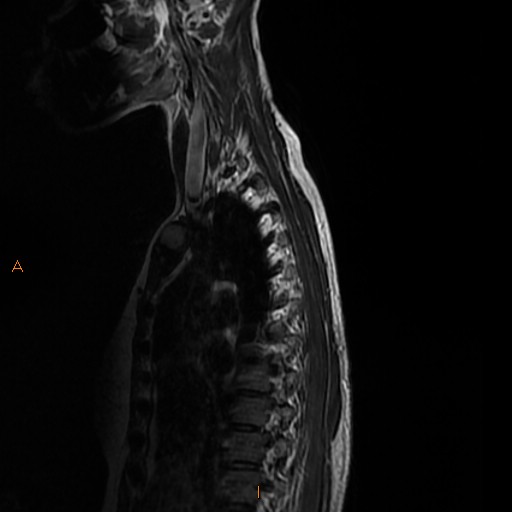 File:Normal spine MRI (Radiopaedia 77323-89408 E 2).jpg