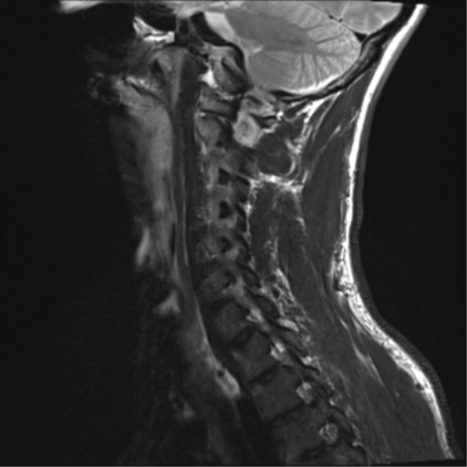 File:Normal trauma cervical spine (Radiopaedia 41017-43762 Sagittal T2 12).png