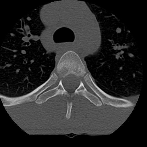 File:Normal trauma spine imaging (age 16) (Radiopaedia 45335-49358 Axial bone window 107).jpg