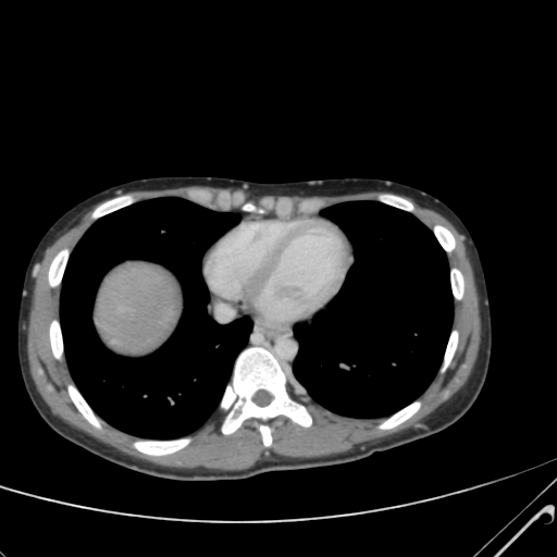 File:Nutmeg liver- Budd-Chiari syndrome (Radiopaedia 46234-50635 B 3).png