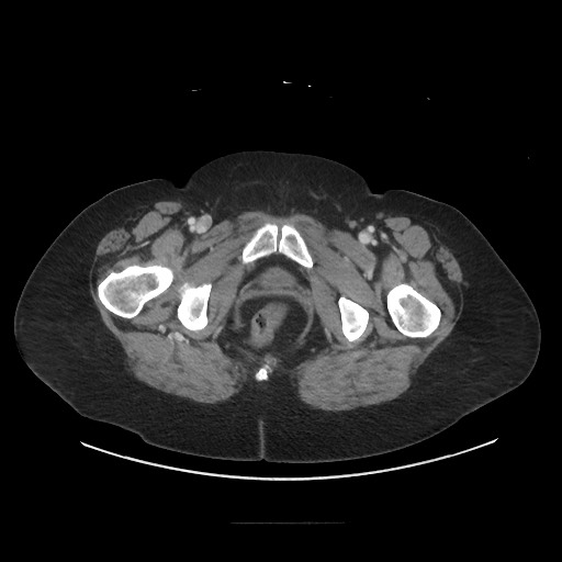 Obstructive distal colonic adenocarcinoma causing cecal perforation (Radiopaedia 86830-102989 A 193).jpg