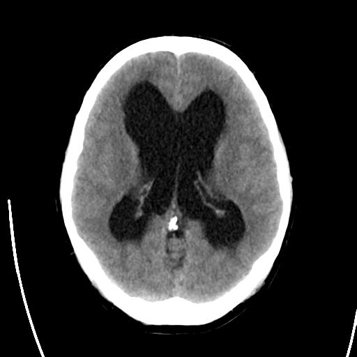 File:Obstructive hydrocephalus (Radiopaedia 30453-31119 Axial non-contrast 14).jpg