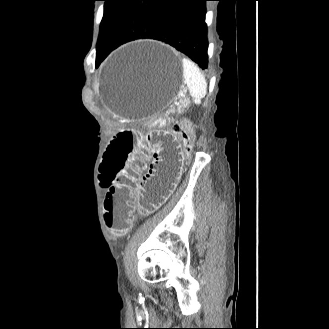 Obturator hernia causing small bowel obstruction (Radiopaedia 65522-74612 C 18).jpg