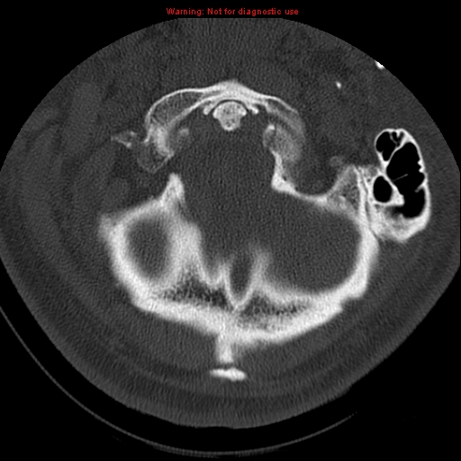 File:Occipital condyle fracture (Radiopaedia 18366-18208 Axial bone window 13).jpg