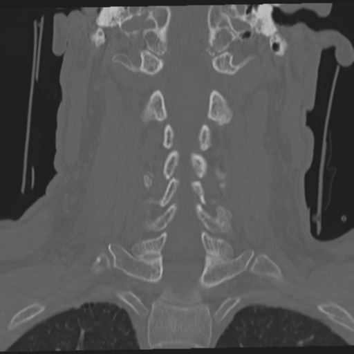 File:Occipital condyle fracture (Radiopaedia 33467-34517 Coronal bone window 37).png