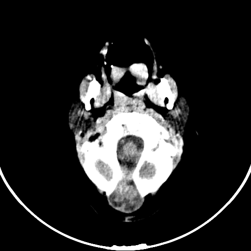 Occipital encephalocele (Radiopaedia 87339-103636 Axial non-contrast 15).jpg