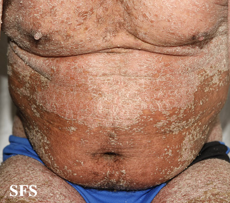 File:Psoriasis (Dermatology Atlas 57).jpg