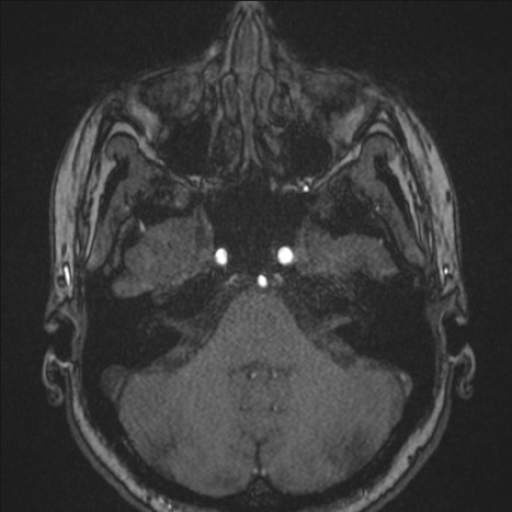 A1 segment hypoplasia (Radiopaedia 83365-97781 Axial TOF MRA 33).jpg