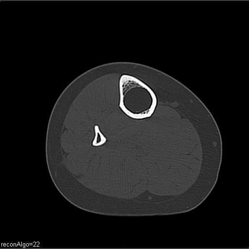File:ACL avulsion fracture (Radiopaedia 33833-34994 Axial bone window 34).jpg