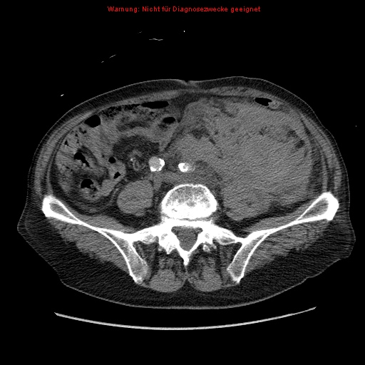 Abdominal aortic aneurysm- extremely large, ruptured (Radiopaedia 19882-19921 Axial C+ arterial phase 51).jpg