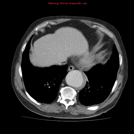 File:Abdominal aortic aneurysm (Radiopaedia 10122-10660 Axial C+ portal venous phase 7).jpg