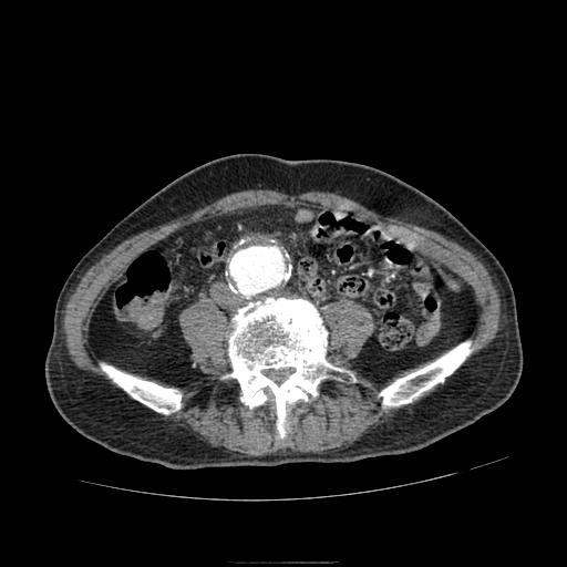 Abdominal aortic aneurysm (Radiopaedia 13341-13340 Axial C+ arterial phase 142).jpg