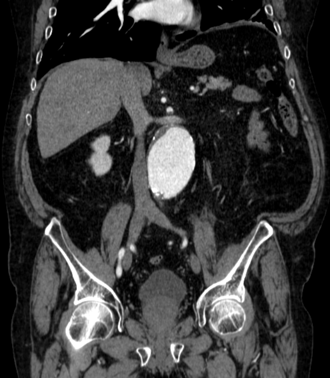 Abdominal aortic aneurysm (Radiopaedia 25855-26001 Coronal C+ arterial phase 33).jpg