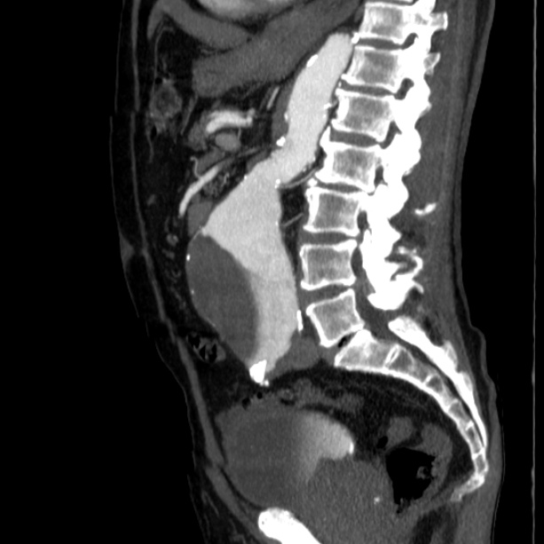 Abdominal aortic aneurysm (Radiopaedia 29248-29660 Sagittal C+ arterial phase 29).jpg