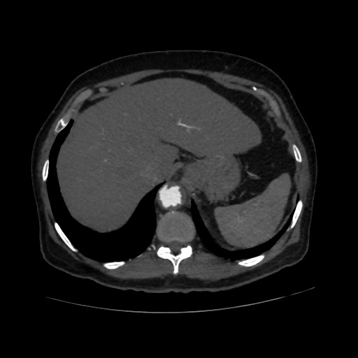 File:Abdominal aortic aneurysm (Radiopaedia 57318-64259 Axial C+ arterial phase 12).jpg