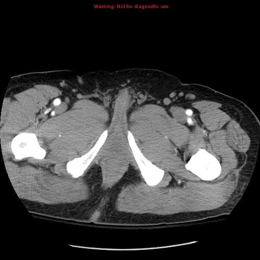 Abdominal aortic aneurysm (Radiopaedia 8190-9038 Axial C+ arterial phase 91).jpg
