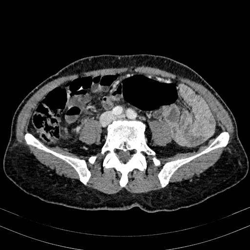 Abdominal aortic aneurysm (Radiopaedia 83581-98689 Axial C+ portal venous phase 72).jpg