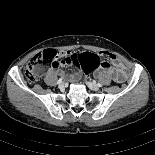 File:Abdominal aortic aneurysm (Radiopaedia 83581-98689 Axial C+ portal venous phase 83).jpg