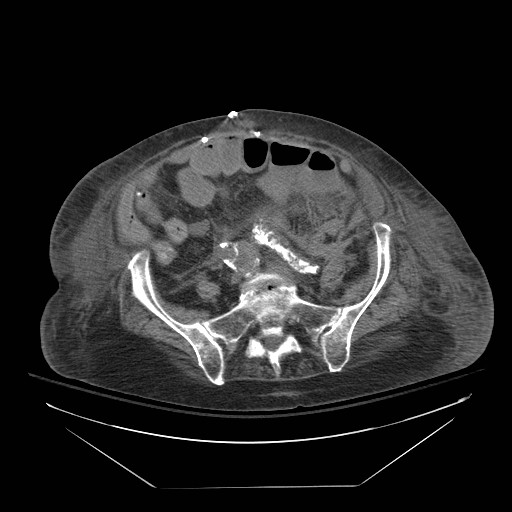 Abdominal aortic aneurysm - impending rupture (Radiopaedia 19233-19247 Axial non-contrast 119).jpg
