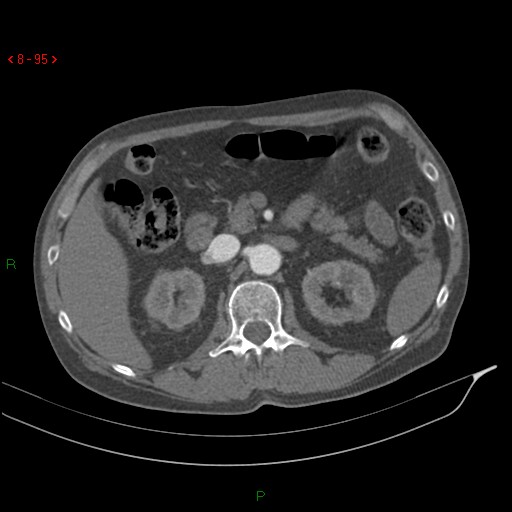 Abdominal aortic aneurysm rupture with aortocaval fistula (Radiopaedia 14897-14841 Axial C+ arterial phase 95).jpg