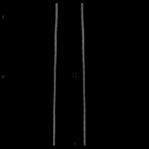File:Abdominal aortic aneurysm rupture with aortocaval fistula (Radiopaedia 14897-14841 Coronal C+ arterial phase 46).jpg