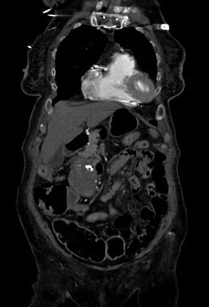 Abdominal aortic aneurysm with thrombus fissuration (Radiopaedia 73192-83919 Coronal C+ arterial phase 12).jpg