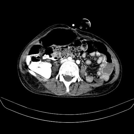 File:Abdominal collection due to previous cecal perforation (Radiopaedia 80831-94320 Axial C+ portal venous phase 120).jpg