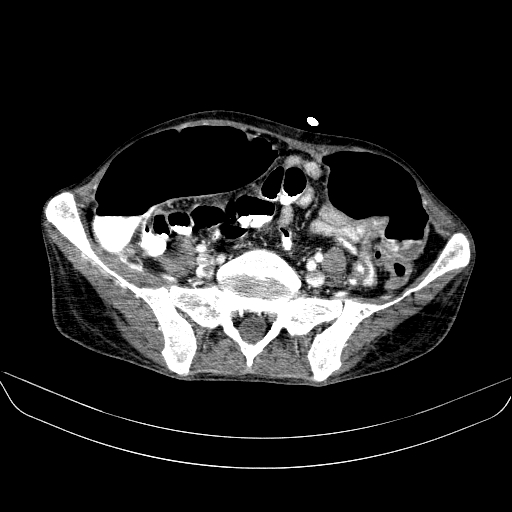 File:Abdominal collection due to previous cecal perforation (Radiopaedia 80831-94320 Axial C+ portal venous phase 146).jpg
