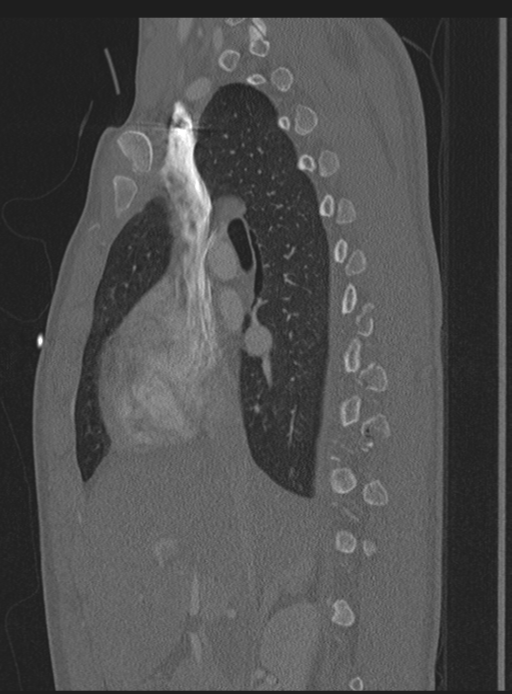 Abdominal multi-trauma - devascularised kidney and liver, spleen and pancreatic lacerations (Radiopaedia 34984-36486 Sagittal bone window 49).png