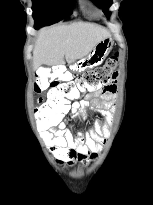 Abdominal wall and retroperitoneal tuberculosis (Radiopaedia 88137-104729 Coronal C+ portal venous phase 21).jpg