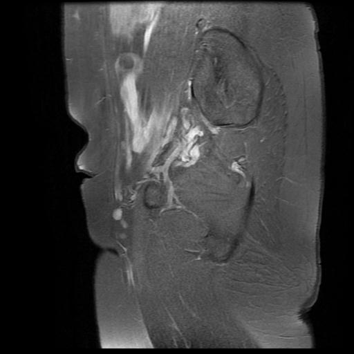 File:Abdominal wall endometriosis (Radiopaedia 83702-98847 Sagittal T1 C+ fat sat 15).jpg