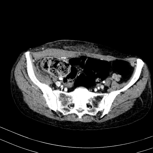 File:Abdominal wall hematoma with active bleeding (Radiopaedia 83915-99117 Axial renal cortical phase 103).jpg