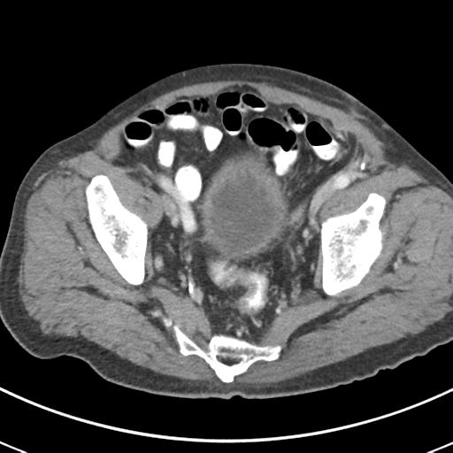Abdominal wall metastasis from colorectal carcinoma (Radiopaedia 31016-31717 Axial C+ portal venous phase 65).jpg