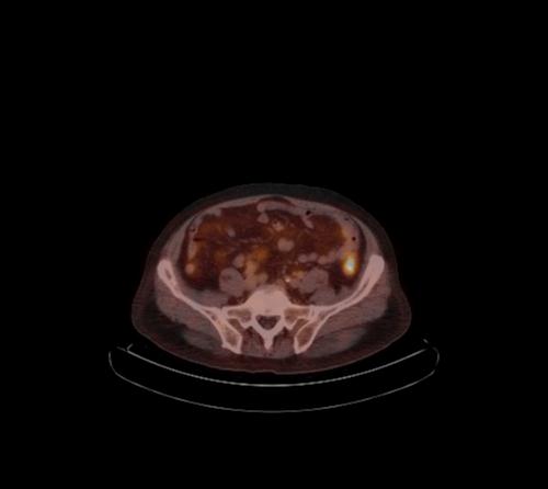 Abdominal wall metastasis from colorectal carcinoma (Radiopaedia 31016-31719 C 44).jpg