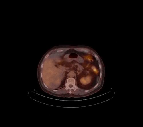 Abdominal wall metastasis from colorectal carcinoma (Radiopaedia 31016-31719 C 82).jpg