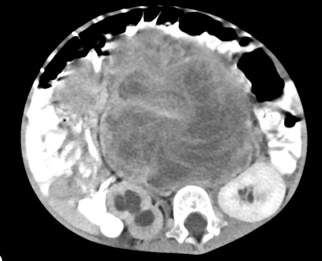 File:Abdominopelvic rhabdomyosarcoma (Radiopaedia 78356-90984 Axial C+ portal venous phase 90).jpg