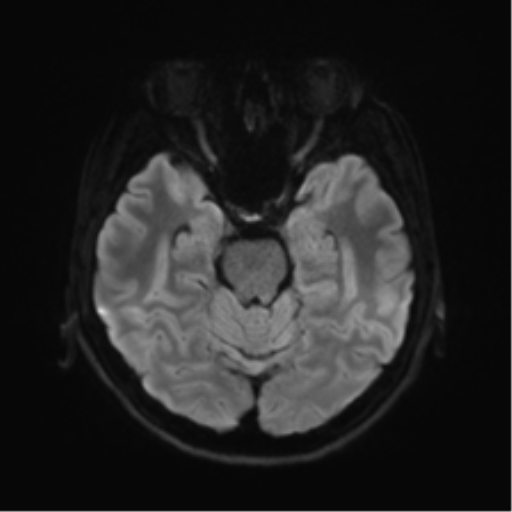 File:Abducens nerve palsy (Radiopaedia 51069-56648 Axial DWI 36).png