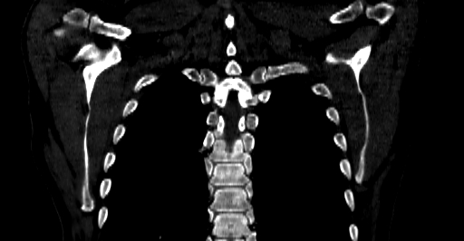 Accesory rib joint (Radiopaedia 71987-82452 Coronal bone window 53).jpg