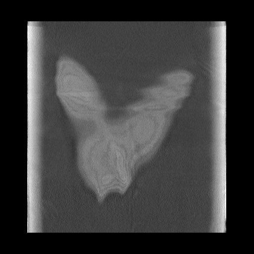 Accessory left horizontal fissure with lingular pneumonia (Radiopaedia 53763-59843 Coronal lung window 47).jpg