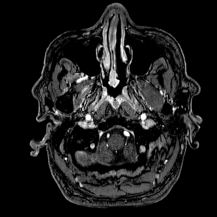 Accessory middle cerebral artery (Radiopaedia 73114-83828 Axial MRA 4).jpg