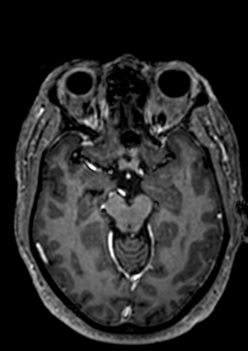 Accessory middle cerebral artery (Radiopaedia 73114-83828 Axial T1 C+ 74).jpg