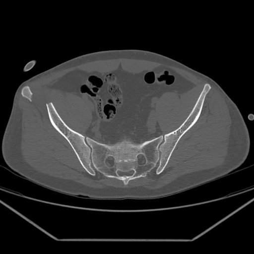 Acetabular and ilial fractures (Radiopaedia 59084-66378 Axial bone window 24).jpg