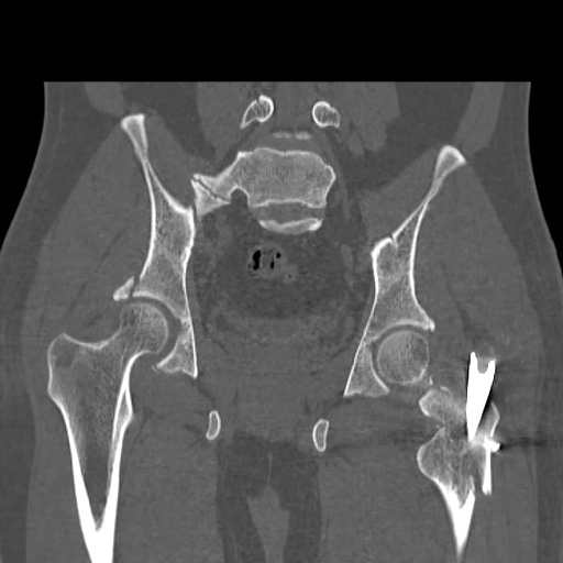 Acetabular and ilial fractures (Radiopaedia 59084-66378 Coronal bone window 32).jpg