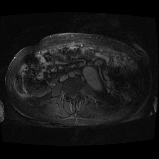 File:Acinar cell carcinoma of the pancreas (Radiopaedia 75442-86668 Axial 362).jpg